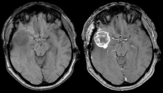 $T_1$-weighted MRI without (left) and with (right) contrast agent